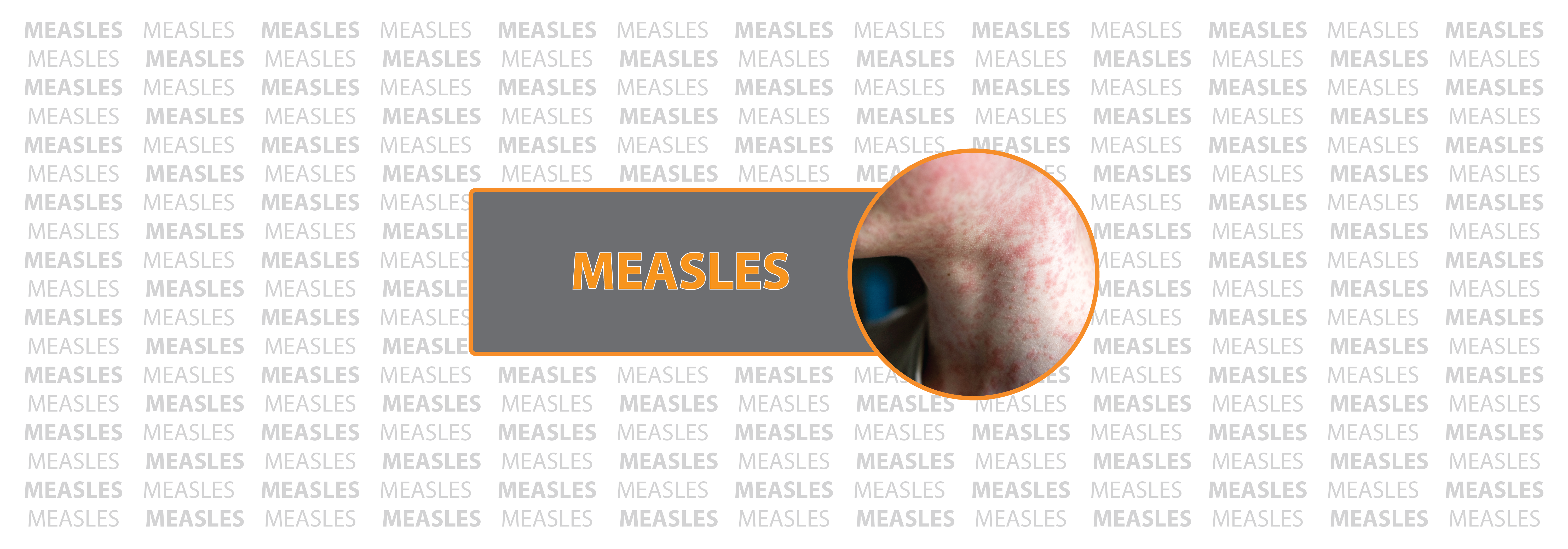 Measles